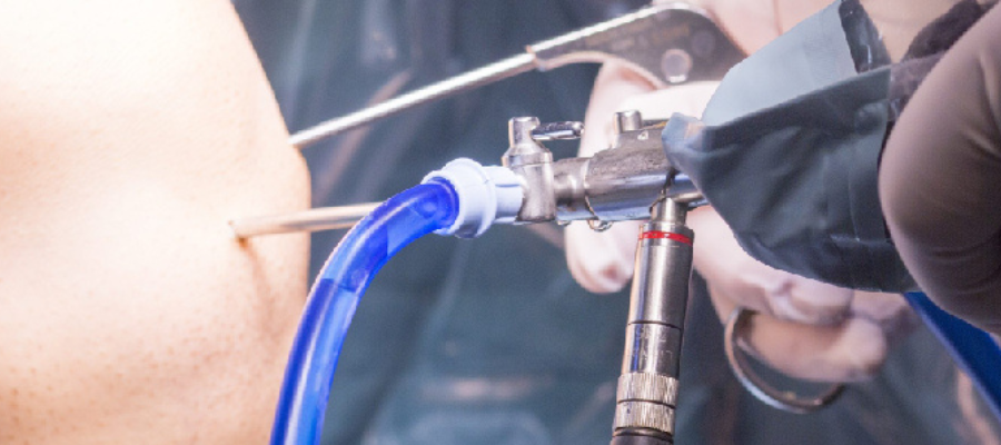Knee Arthroscopy