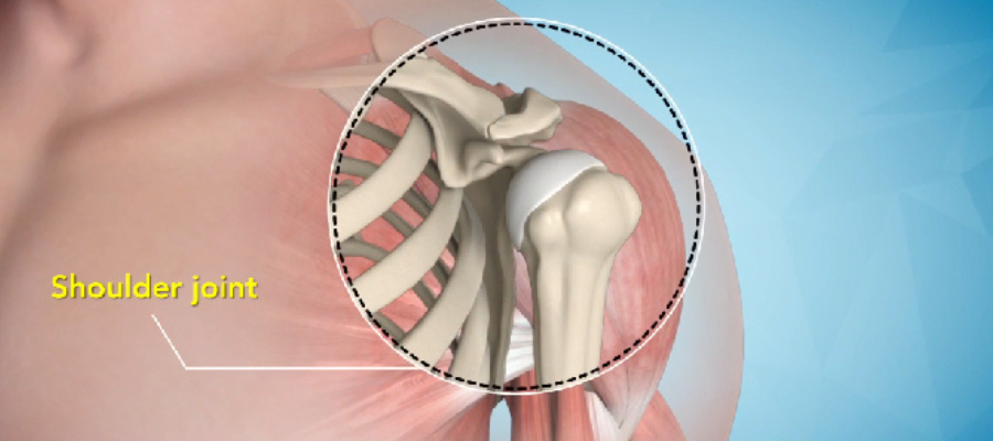 Shoulder Joint Replacement